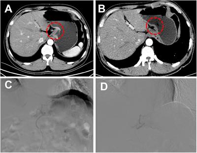 Transcatheter arterial chemoembolization combined with apatinib and camrelizumab for unresectable advanced gastric or gastroesophageal junction cancer: a single-arm, single-center, retrospective study